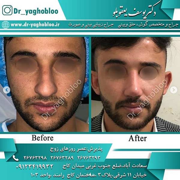 جراحی بینی در تهران