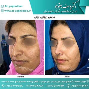 جراحی بینی زنان