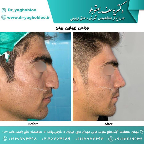 جراحی بینی در تهران