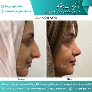 nose surgery (105)