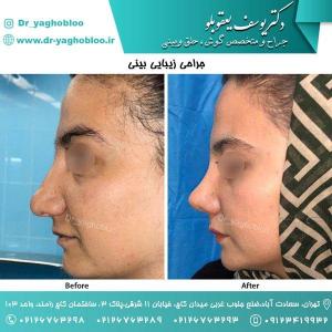nose surgery (114) (1)