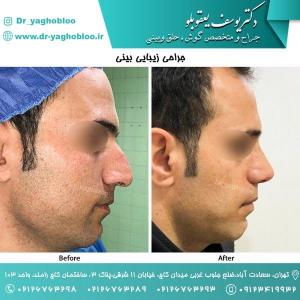 nose surgery (129)