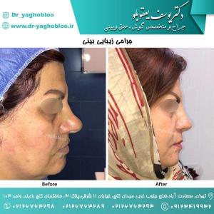 nose surgery (150)