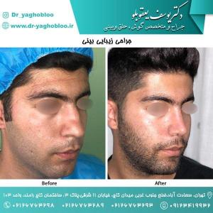 nose surgery (151) (1)