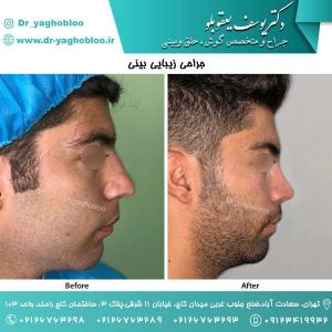 nose surgery (157)