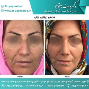nose surgery (45) (1)