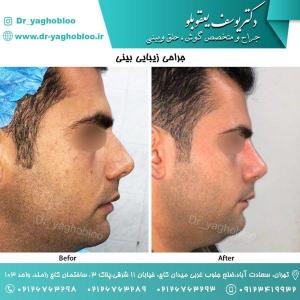 nose surgery (53)