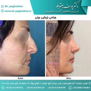 nose surgery (57) (1)