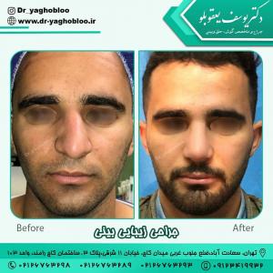 جراحی-بینی-در-تهران591