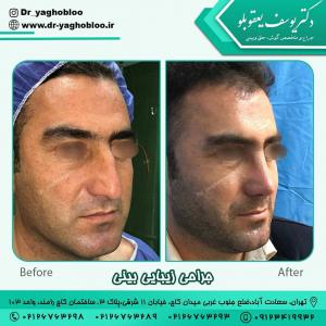 جراحی-بینی-در-تهران593