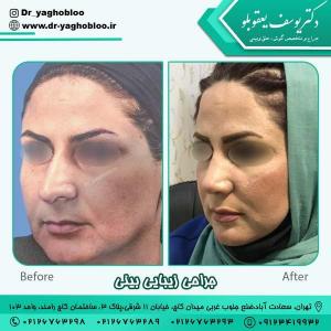 جراحی بینی در تهران 17