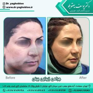 جراحی بینی در تهران 18