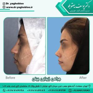 جراحی بینی در تهران 5