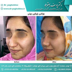 جراحی بینی زنان