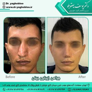 جراحی بینی - دکتر یعقوبلو