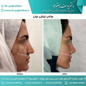 nose surgery (166)