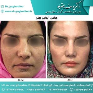 nose surgery (49) (1)