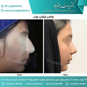 nose surgery (60) (1) (1)