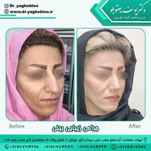 جراحی بینی در تهران 10
