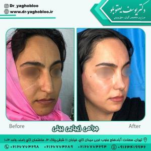جراحی بینی در تهران 12