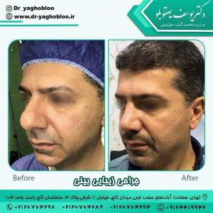 جراحی-بینی-در-تهران492